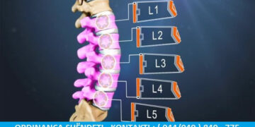 Trajtimi Efektiv I Spondilozes Lumbare Ne Rruazat L4-L5