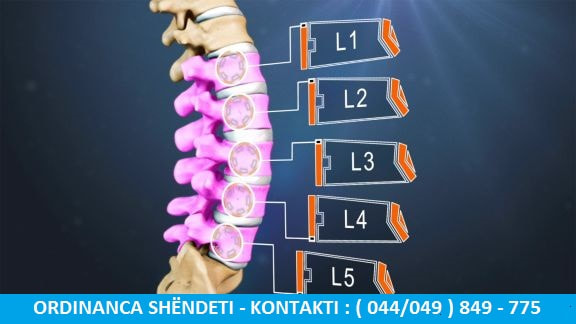 Trajtimi Efektiv I Spondilozes Lumbare Ne Rruazat L4-L5